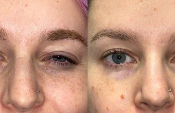 patient had an ptosis repair and revisional eyelid surgery shown before (left) and after (right)