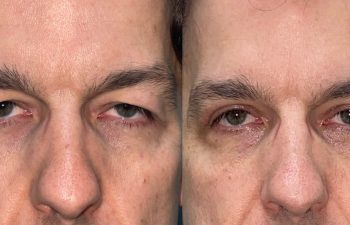 patient had upper blepharoplasty before (left) after 4 weeks (right)