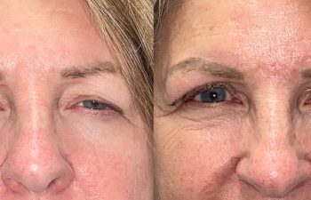 patient had upper blepharoplasty shown before (left) and after 1 week (right)