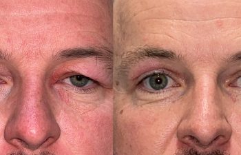 patient had upper blepharoplasty and brow & forehead surgery shown before (left) and after 6 weeks (right)