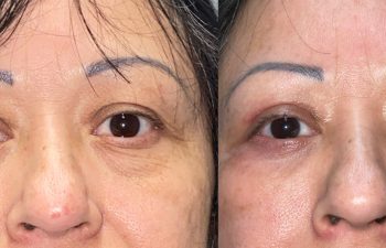 patient had upper blepharoplasty and lower blepharoplasty shown before (left) and after 6 weeks (right)
