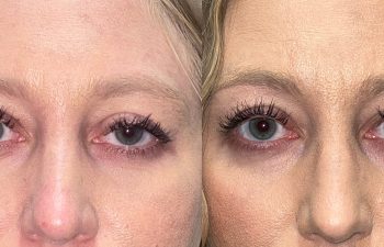 patient had ptosis repair shown before (left) and after 1 week (right)