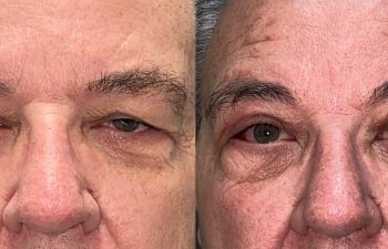 patient had upper blepharoplasty, brow & forehead surgery and ptosis repair shown before (left) and after 2 months (right)
