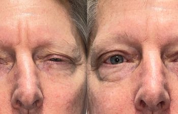 patient had upper blepharoplasty, ptosis repair and brow & forehead surgery shown before (left) and after 2 months (right)