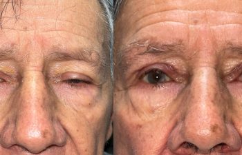 patient had ptosis repair and brow & forehead surgery shown before (left) and after 6 weeks (right)