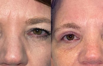 patient had upper blepharoplasty shown before (left) and after 1 month (right)