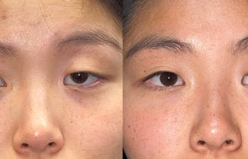 patient had ptosis repair and asian eyelid surgery shown before (left) and after (right)
