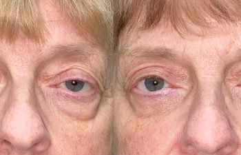 patient had upper blepharoplasty, lower blepharoplasty and ptosis repair shown before (left) and after 2 months (right)