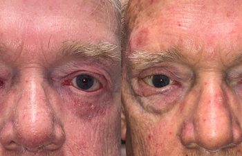 patient had a reconstructive shown before (left) and after (right)