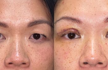 patient had asian eyelid surgery shown before (left) and after (right)