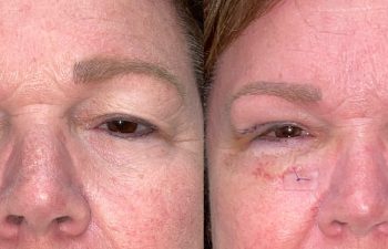 patient had upper blepharoplasty, lower blepharoplasty and brow & forehead surgery shown before (left) and after 1 week (right)