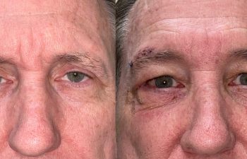 patient had upper blepharoplasty, lower blepharoplasty, brow & forehead surgery shown before (left) and after 1 week (right)