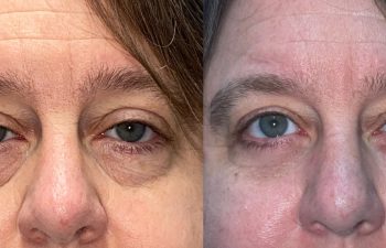 patient had lower blepharoplasty, fat grafting and ptosis repair shown before (left) and after 2 months (right)