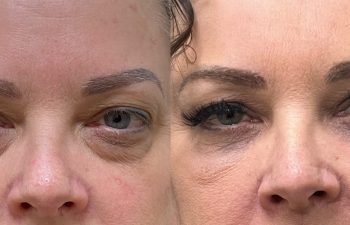 patient had lower blepharoplasty shown before (left) and after 2 months (right)