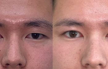 patient had upper blepharoplasty and asian eyelid surgery shown before (left) and after (right)