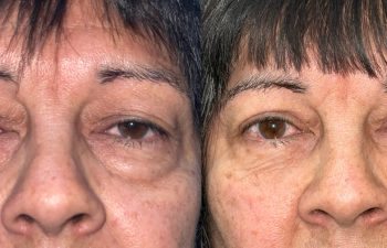patient had upper blepharoplasty, lower blepharoplasty, fat grafting and ptosis repair shown before (left) and after (right)