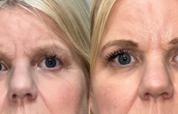 patient had upper blepharoplasty, fat grafing and brow & forehead surgery shown before (left) and after 4 months (right)