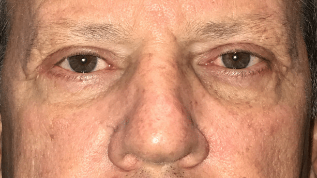 male patient after brow ptosis sagging eyelids