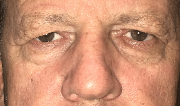 male patient before brow ptosis sagging eyelids
