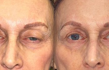 patient had upper blepharoplasty and ptosis repair shown before (left) and after 3 months (right)