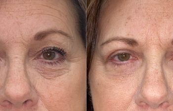 patient had upper blepharoplasty, ptosis repair and lower blepharoplasty shown before (left) and after 6 weeks (right)