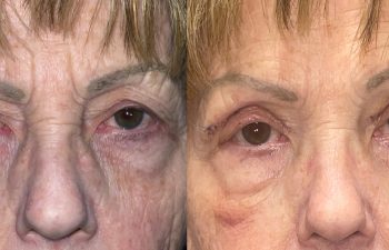 patient had upper blepharoplasty shown before (left) and after 1 week (right)