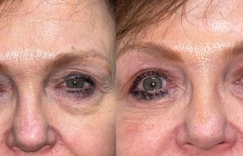 patient had upper blepharoplasty, ptosis repair and lower blepharoplasty shown before (left) and after 6 weeks (right)