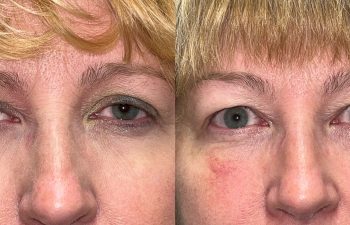 patient had upper blepharoplasty and ptosis repair shown before (left) and after 1 week