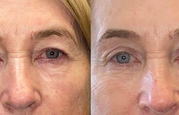 patient had upper blepharoplasty and brow lift shown before (left) and after 2 months (right)