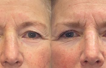 patient had upper blepharoplasty shown before (left) and after 3 weeks (right)