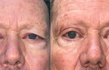 patient had upper blepharoplasty and brow & forehead surgery shown before (left) and after 6 weeks (right)