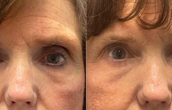 patient had ptosis repair shown before (left) and after 2 weeks (right)