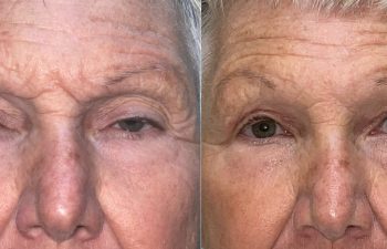patient had ptosis repair shown before (left) and after 10 days (right)