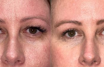 patient had upper blepharoplasty, ptosis repair and brow & forehead surgery shown before (left) and after 6 weeks (right)