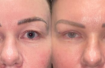 patient had upper blepharoplasty shown before (left) and after 1 week (right)