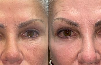 patient had revisional eyelid surgery shown before (left) and after 2 months (right)