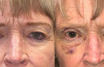 patient had upper blepharoplasty and ptosis repair shown before (left) and after 1 week (right)