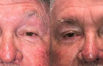 patient had reconstructive shown before (left) and after 3 months (right)
