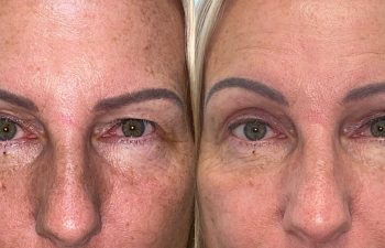 patient had upper blepharoplasty, revisional eyelid surgery and brow & forehead surgery shown before (left) and after 1 month (right)
