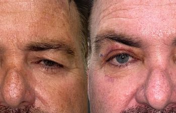 patient had upper blepharoplasty and brow & forehead surgery before (left) and after 1 week (right)