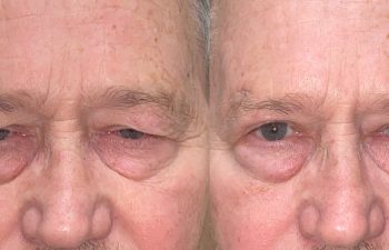 patient had upper blepharoplasty, ptosis repair and brow repair shown before (left) and after 2 months (right)