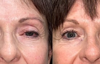 patient had and upper blepharoplasty and ptosis repair shown before (left) and after (left)