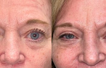 patient had upper blepharoplasty, lower blepharoplasty, brow & forehead surgery and fat grafting shown before (left) and after 4 weeks (right)