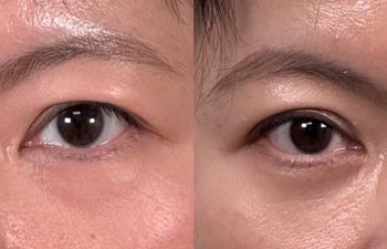 patient after asian eyelid surgery shown frontal view before (left) and 9 weeks after (right)