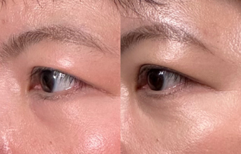 patient after asian eyelid surgery shown frontal view before (left) and 9 weeks after (right)