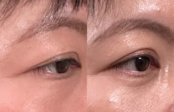 patient after asian eyelid surgery shown frontal view before (left) and 9 weeks after (right)