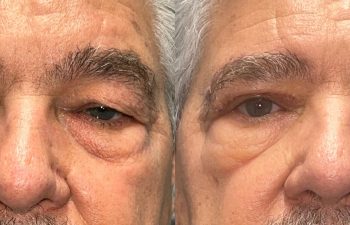 patient had bilateral ptosis repair and brow lift shown before (left) and 10 days after (right)