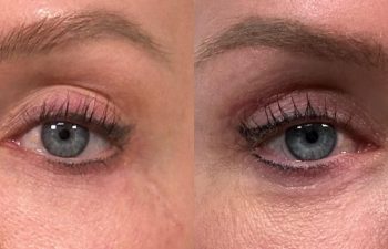 patient had mini upper blepharoplasty shown frontal before (left) and 2 months after (right)