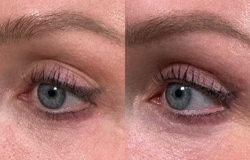patient had mini upper blepharoplasty shown left oblique before (left) and 2 months after (right)