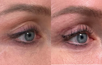 patient had mini upper blepharoplasty shown right oblique before (left) and 2 months after (right)